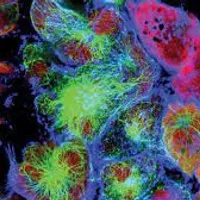 Nivelul ridicat de colesterol alimentează tumorile, conferind rezistenţă celulelor canceroase / science