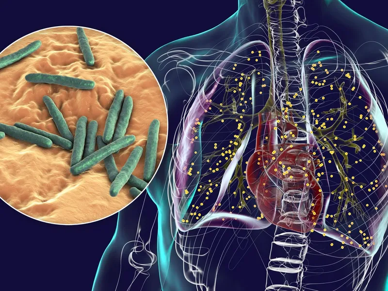 Afecțiunea medicală gravă care a devenit principala cauză de deces din bolile infecțioase - Foto: Profimedia images