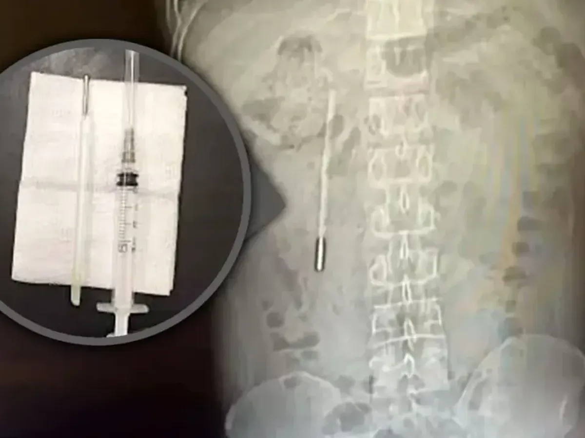 Caz șocant în China. Un bărbat a stat 20 de ani cu un termometru cu mercur în stomac