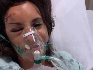 FOTO ȘOCANT! O prezentatoare TV a suferit un accident îngrozitor și nu-și mai aduce nimic aminte: 'Este tot ce vă pot spune'