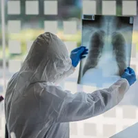 Radiografie pulmonară a unui bolnav de COVID/FOTO: Getty