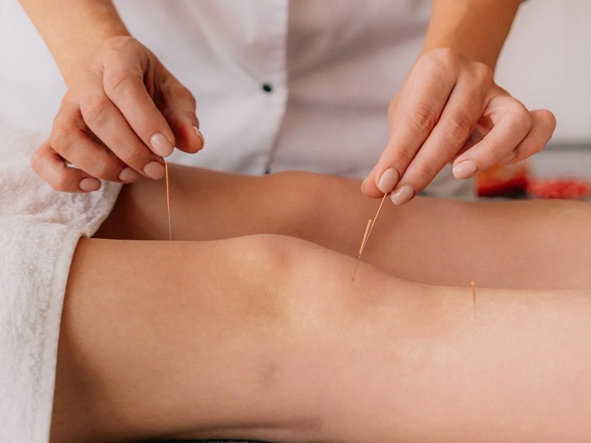 Acupunctură
