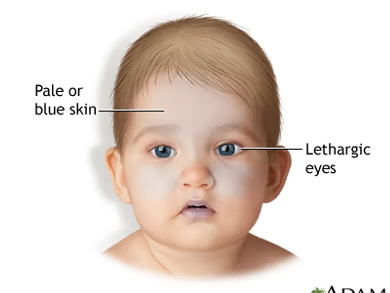 Sindromul copilului zgâlțâit, shaken baby syndrome Foto: U.S. National Library of Medicine