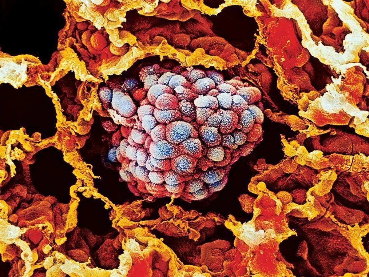 Un prim-plan al celulelor canceroase înglobat în țesutul pulmonar