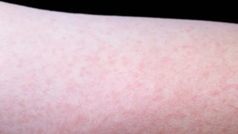 Epidemie de rujeolă în România! Anunțul Ministerului Sănătății: „29 de județe afectate” - Foto: Profimedia Images/ Imagine cu caracter ilustrativ