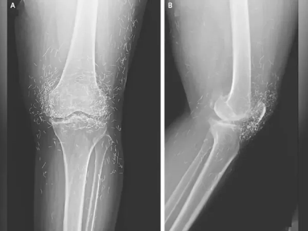 Radiografie genunchi