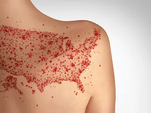 SĂNĂTATE PUBLICĂ  Scăderea nivelului de vaccinare - exacerbat de pandemia COVID-19 - amenință cu revenirea rujeolei