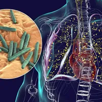 Afecțiunea medicală gravă care a devenit principala cauză de deces din bolile infecțioase - Foto: Profimedia images