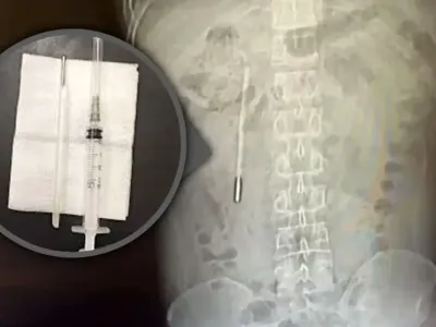 Caz șocant în China. Un bărbat a stat 20 de ani cu un termometru cu mercur în stomac - Foto: scmp.com