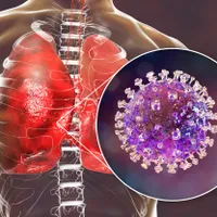 Focar de virus Nipah, în India. Nu există un vaccin, rata de mortalitate este între 40% și 75% - Foto: Profimedia Images