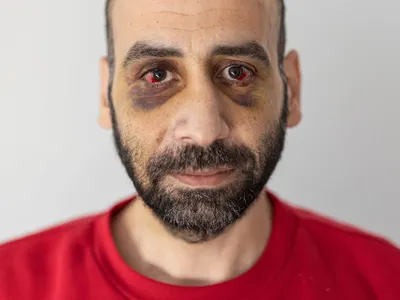 Youssef Atallah , un migrant sirian bătut de forțele din Belarus/foto: reuters