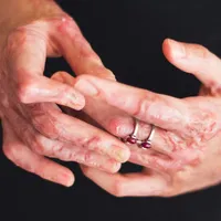 Urmele lăsate de arsurile suferite de victimele de la Colectiv/Foto: Europa FM