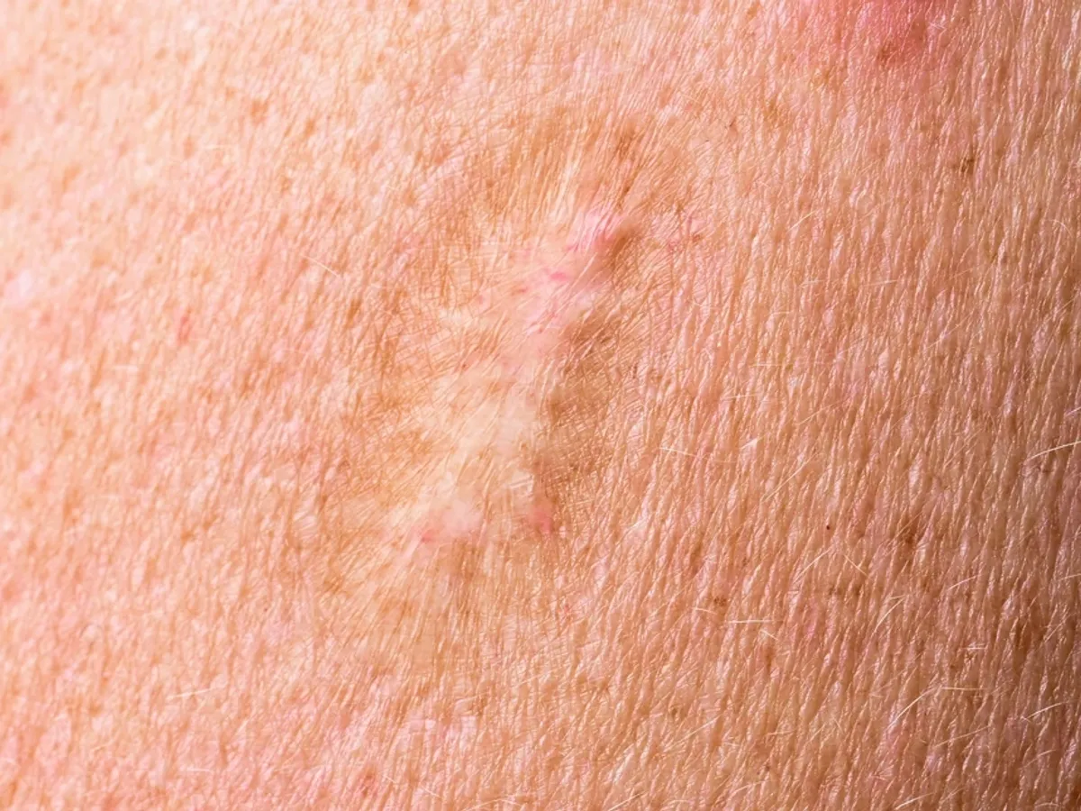 Cicatrici Foto: Porfimedia (imagine cu rol ilustrativ)