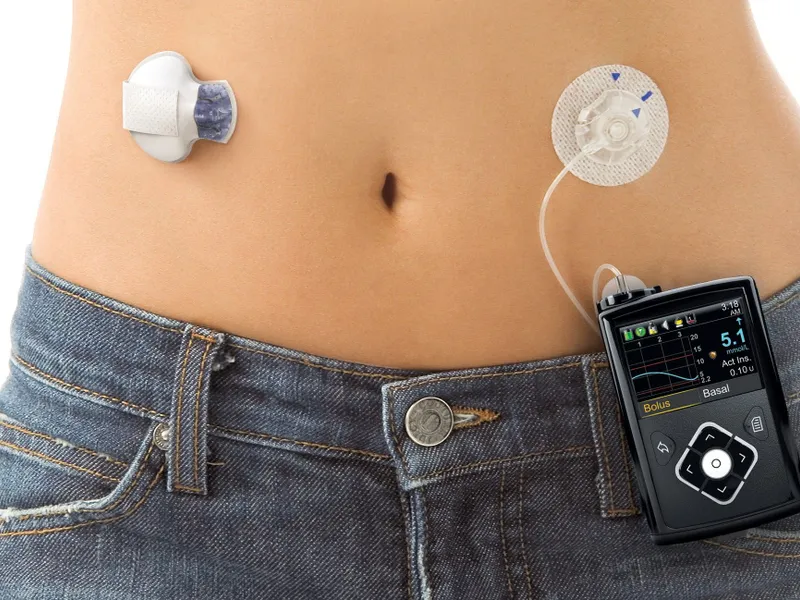 „Pancreas artificial”/Foto: medical device