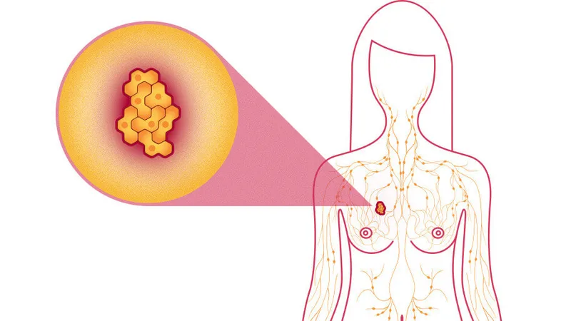 Un medicament dezvoltat de AstraZeneca pentru tratarea cancerului la sân, aprobat în SUA. / Foto: niraamayclinic.com