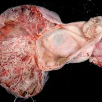 Tumoră în uter mai mare decât un nou-născut: 4,3 kilograme. O femeie a fost la un pas de moarte - Foto: Wikipedia/Ed Uthman - fotografie cu scop informativ