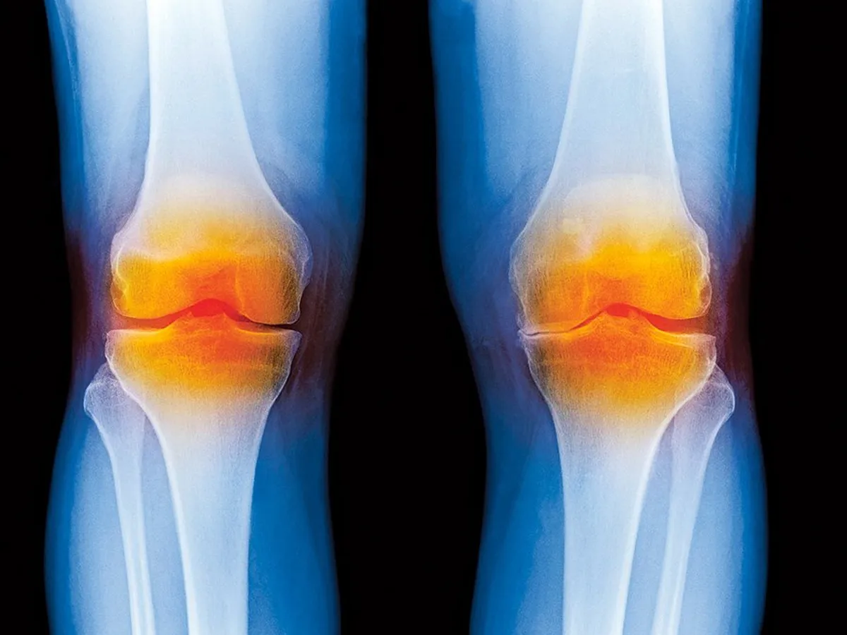 O radiografie a genunchiului unui bărbat de 66 de ani cu osteoartrită