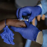 De ce trebuie să ne îngrijoreze variola maimuţei mpox. Va fi sau nu va fi o nouă pandemie? - Foto: Profimedia Images