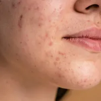 Băutura care îți curăță tenul de acnee și te scapă de roșeață. Îți hidratează tenul și costă 15 lei - Foto: Profimedia / imagine rol ilustrativ
