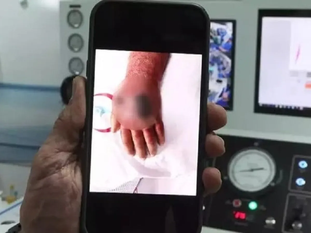 Mână infectată de la mușcătură umană