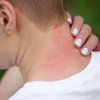 Ingredientul din bucătăria ta care te scapă de mușcăturile de insecte în doar 15 minute. Costă 5 lei - Foto: Profimedia Images (imagine cu rol ilustrativ)