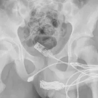 Un tânăr a vrut să-și măsoare "virilitatea" din interiorul corpului cu un cablu USB. A rămas blocat - FOTO: Urology Case Reports