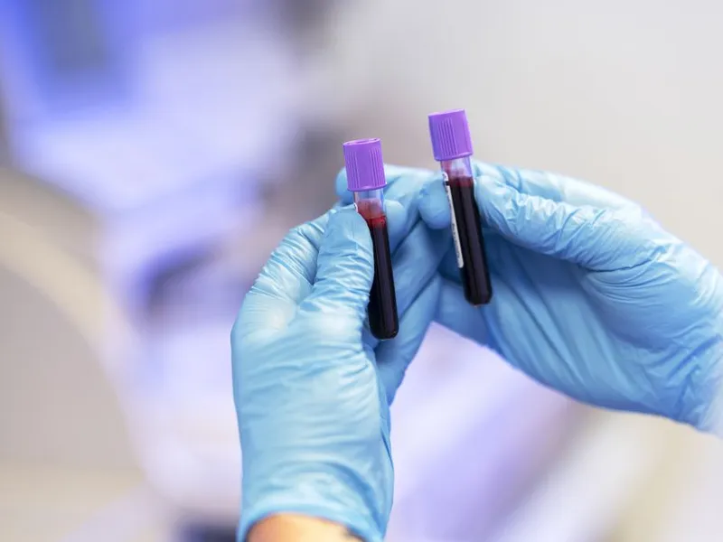 Medic comparând două probe de sânge - Foto: Freepik/CC0