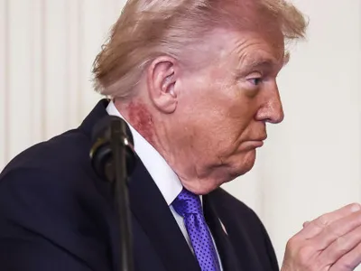 Noi întrebări despre starea de sănătate a lui Donald Trump. Ce este pata roșie apărută pe gâtul președintelui american