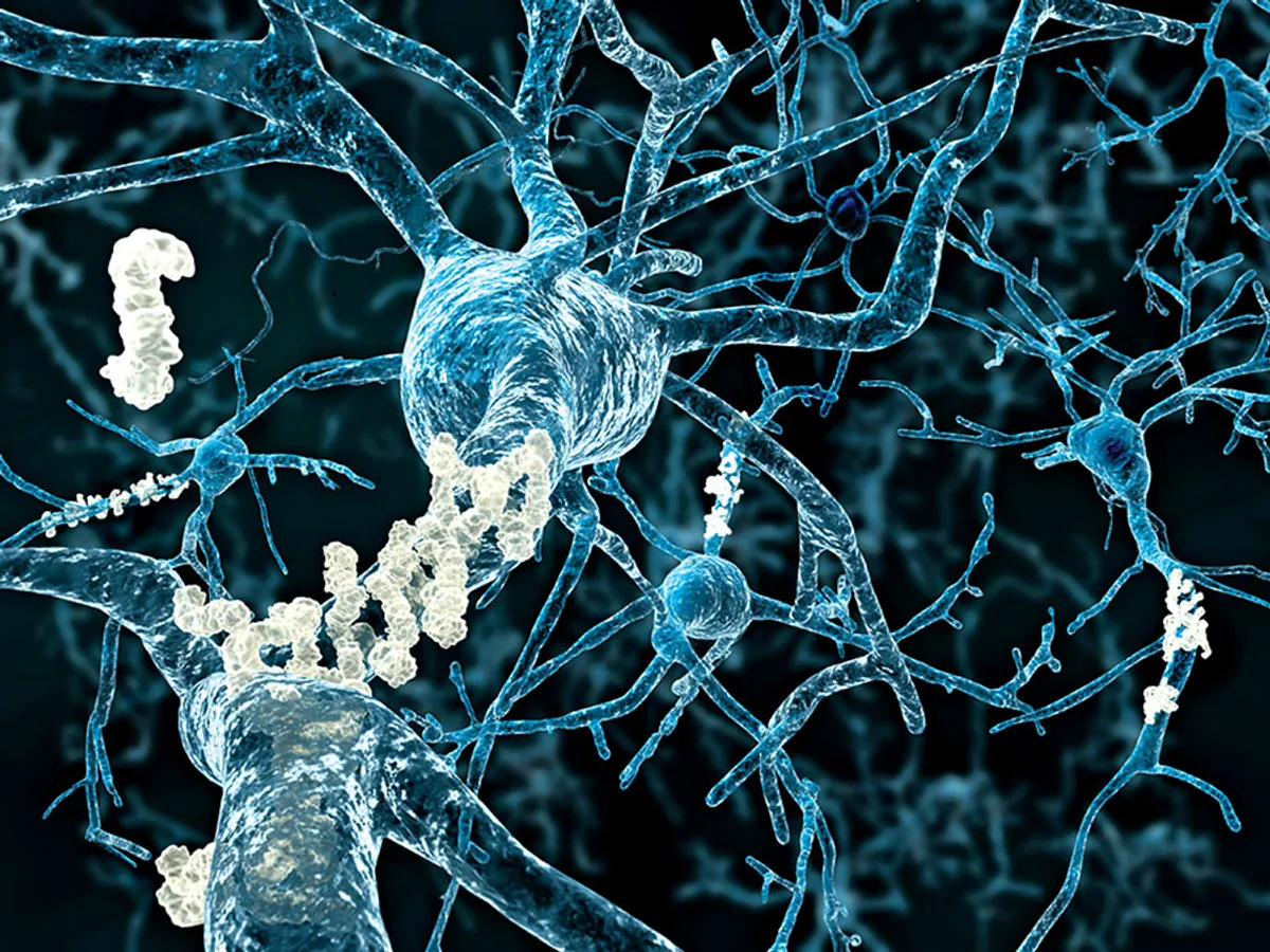 Celule cerebrale cu plăci amiloide