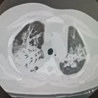 Plămânii unui tânăr care s-a tratat cu ivermectină. Sursă foto: Facebook
