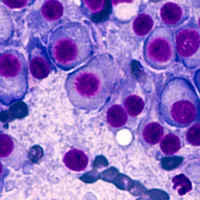 Cum se tratează mielomul multiplu, un cancer rar de sânge