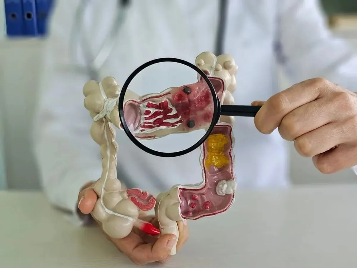 Cancer de colon de care suferă Mihai Leu, cel mai răspândit în România. Care sunt semnele bolii? - Foto: Profimedia Images (imagine cu rol ilustrativ)