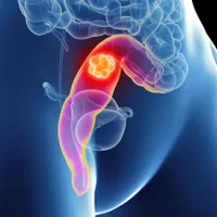 Speranță, pentru bolnavii de cancer colorectal. Un „cocteil” de medicamente micşorează tumorile - Foto: piedmontcolorectal.com