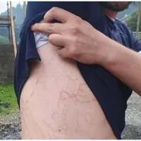 Semnele apărute pe corpul unui bărbat după ce fulgerul a lovit pământul la câțiva metrii de el - Foto: Sallvamont