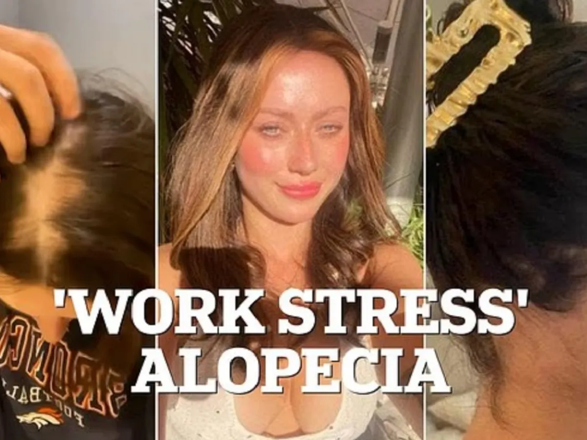 Tânără cu alopecie - Foto: Daily Mail