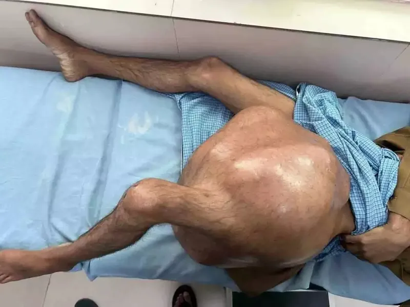Un om a ajuns pe mâna medicilor cu o tumoră de peste 34 de kilograme. Cum a scăpat de ea? - Foto: Arhivs