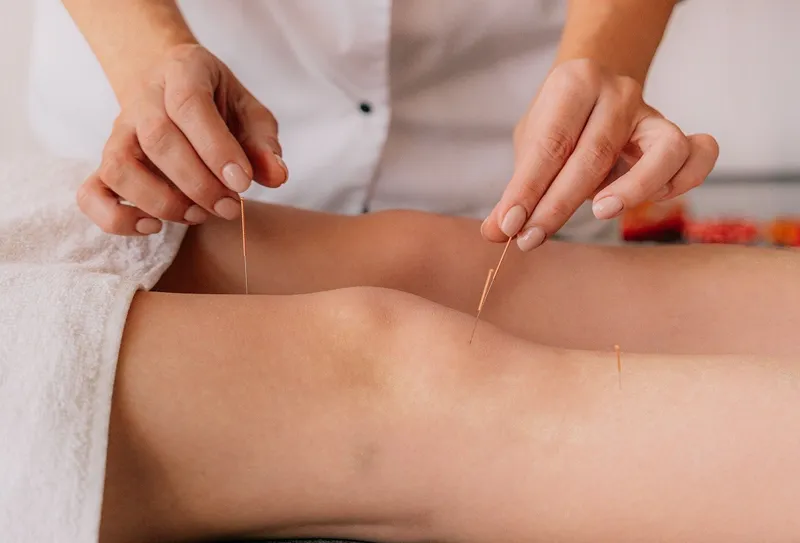 Acupunctură