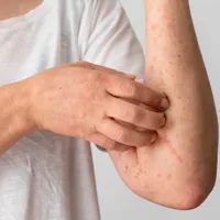 Care sunt cauzele dermatitei și cum o tratezi? Afectează 2% din populația globală - Foto: Freepik.com (Imagine cu caracter ilustrativ)