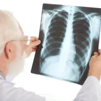 Epidemie de tuberculoză, combătută cu țigări și ciocolată. 700.000 persoane examinate în 5 săptămâni - Foto: Freepik (Imagine cu rol ilustrativ)
