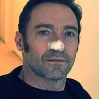 Hugh Jackman după intervenție- Foto: Daily Mail