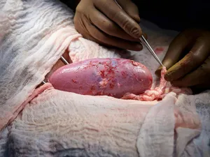 Un rinichi de porc, transplantat în premieră la om fără a se declanşa respingerea imediată. / Foto: agerpres.ro