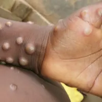 Foto: OMS/Nigeria Centre for Disease Control
