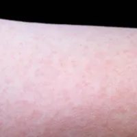 Epidemie de rujeolă în România! Anunțul Ministerului Sănătății: „29 de județe afectate” - Foto: Profimedia Images/ Imagine cu caracter ilustrativ