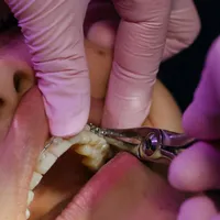 Dosarul stomatologilor ieșeni: Cum răspund medicii la acuzațiile de cartelizare la tarif și angajări - Foto: Pexels/cottonbro studio