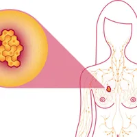 Un medicament dezvoltat de AstraZeneca pentru tratarea cancerului la sân, aprobat în SUA. / Foto: niraamayclinic.com
