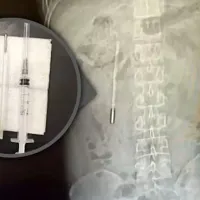 Caz șocant în China. Un bărbat a stat 20 de ani cu un termometru cu mercur în stomac - Foto: scmp.com