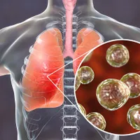 O ciupercă mortală se răspândește rapid la om. 109 persoane infectate, una a murit. 13 în spital - Foto: Profimedia Images - Caracter ilustrativ