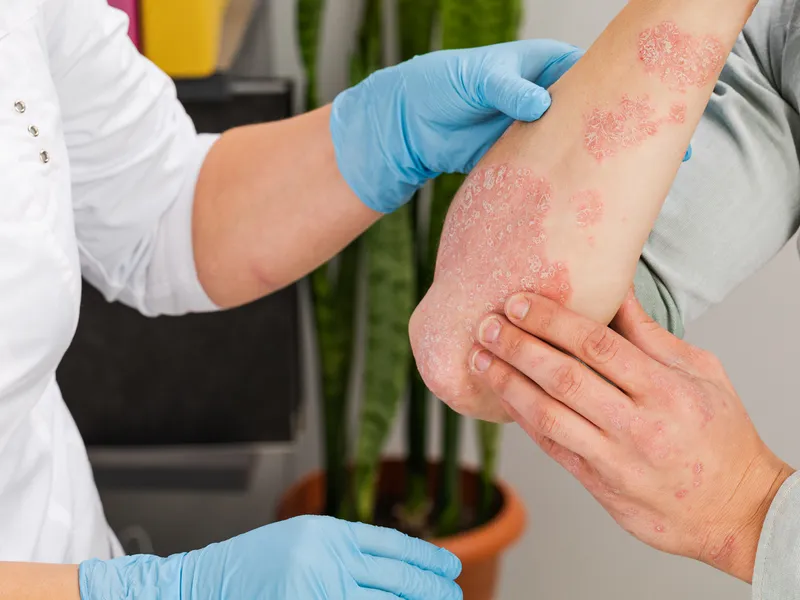 Ai psoriazis pe scalp sau pe corp? Specialiștii testează o spumă topică „minune”, fără steroizi - Foto: Freepik (Imagine cu rol ilustrativ)