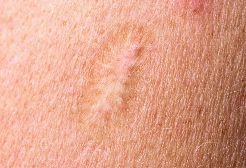 Cicatrici Foto: Porfimedia (imagine cu rol ilustrativ)